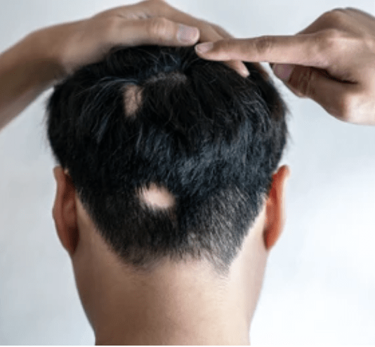 alopecia treatment in dubai
