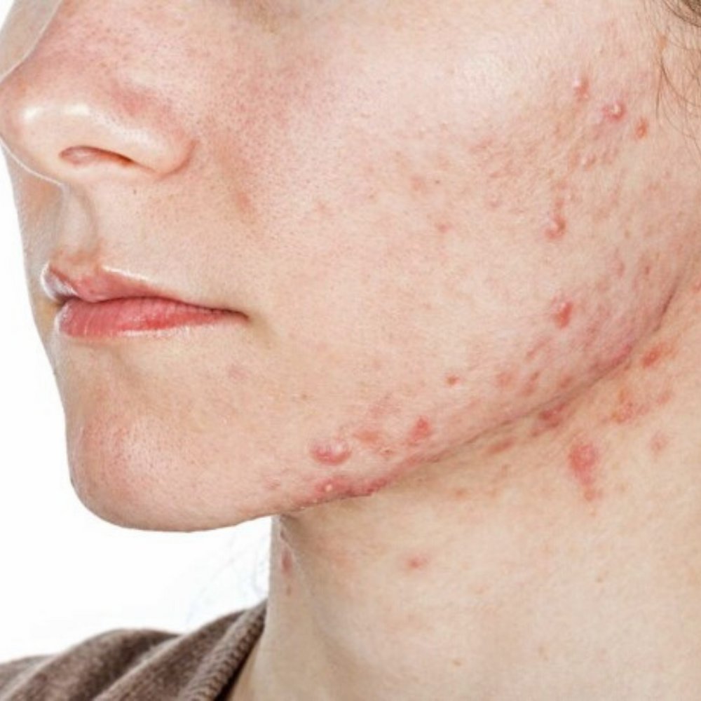 Acne Treatment