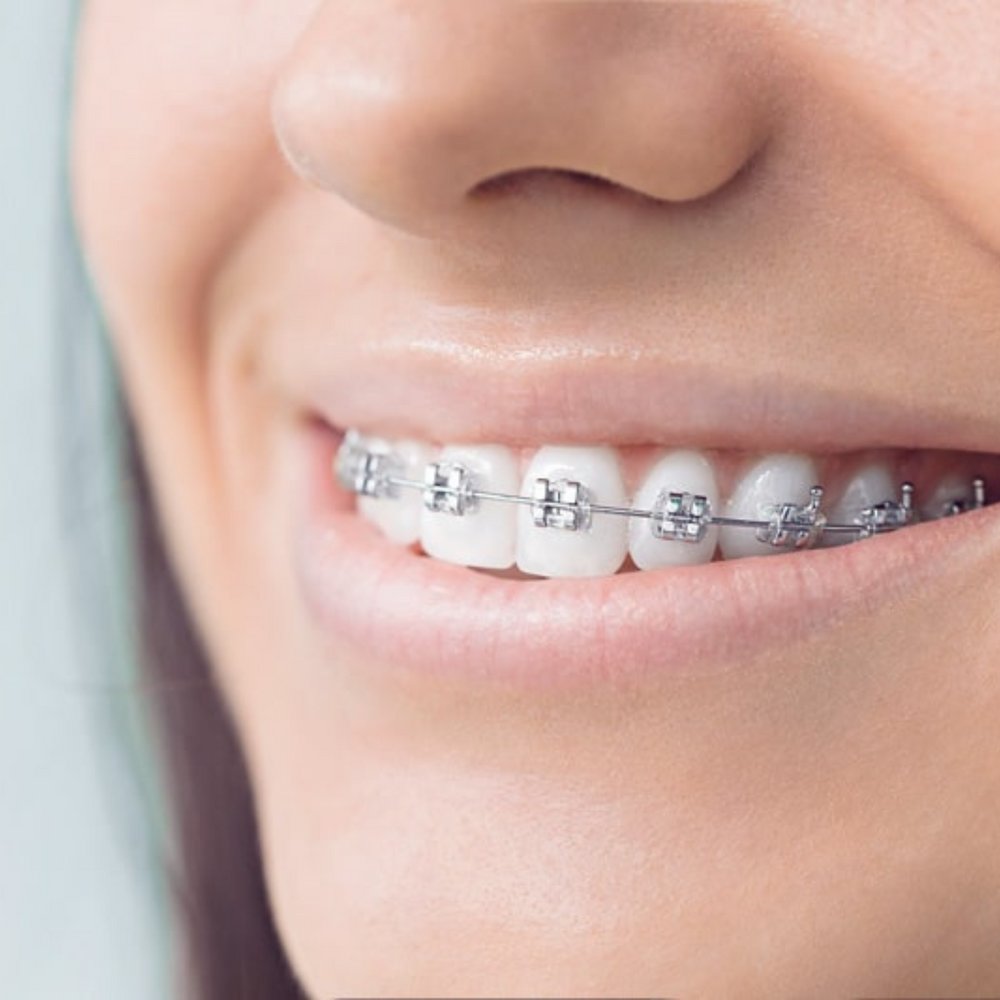 Orthodontics Treatment in skin experts polyclinic dubai