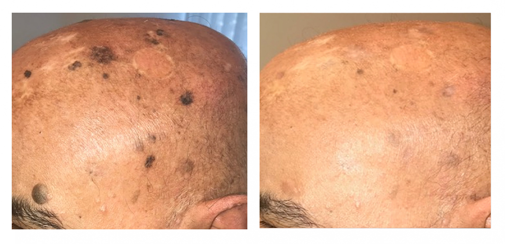 Tumors removed with laser