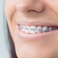 Orthodontics Treatment in skin experts polyclinic dubai